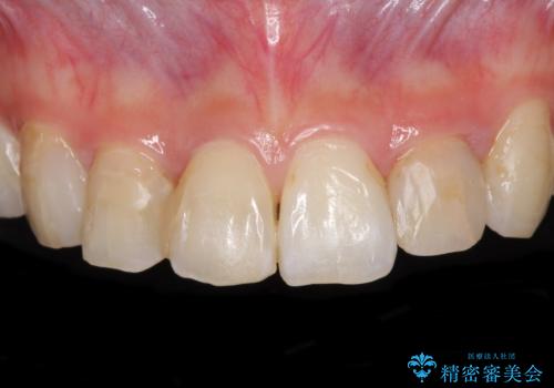継ぎ接ぎだらけの前歯を綺麗にしたい 前歯のオールセラミックの治療前