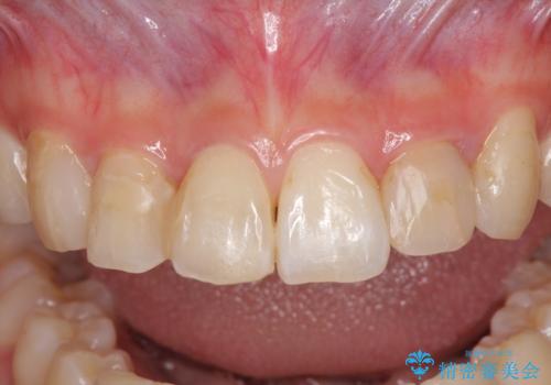 継ぎ接ぎだらけの前歯を綺麗にしたい 前歯のオールセラミックの治療前