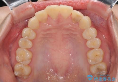 継ぎ接ぎだらけの前歯を綺麗にしたい 前歯のオールセラミックの治療前