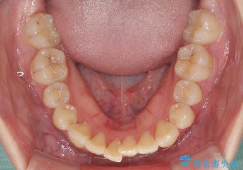継ぎ接ぎだらけの前歯を綺麗にしたい　前歯のオールセラミックの治療前