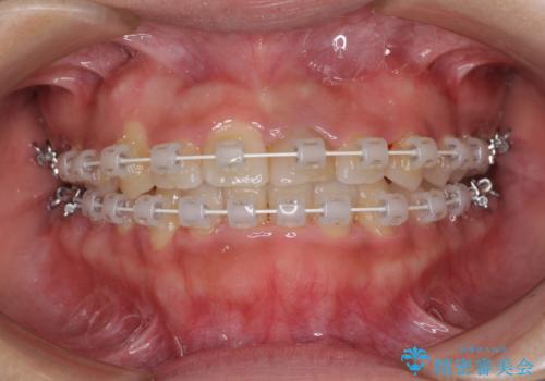 前歯のクロスバイトと変色した歯 ワイヤー矯正とセラミック治療の治療中