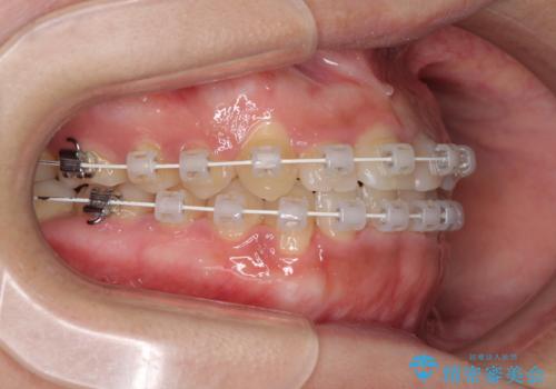 前歯のクロスバイトと変色した歯　ワイヤー矯正とセラミック治療の治療中