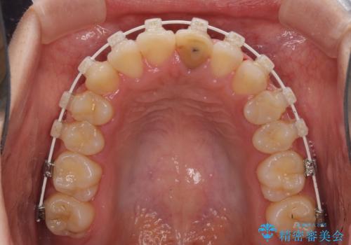 前歯のクロスバイトと変色した歯 ワイヤー矯正とセラミック治療の治療中