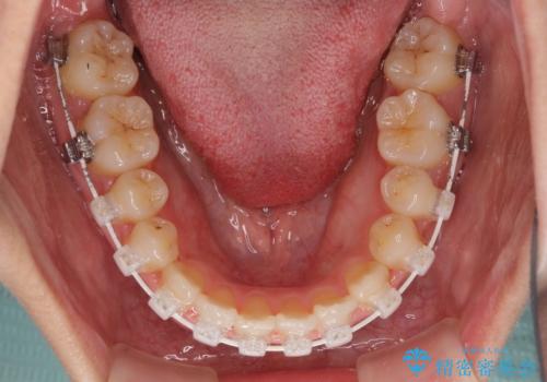 前歯のクロスバイトと変色した歯 ワイヤー矯正とセラミック治療の治療中