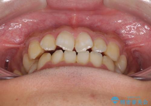 下顎前歯と上顎の部分矯正の治療前