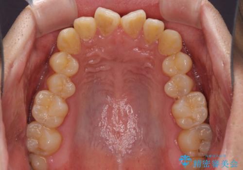 下顎前歯と上顎の部分矯正の治療前