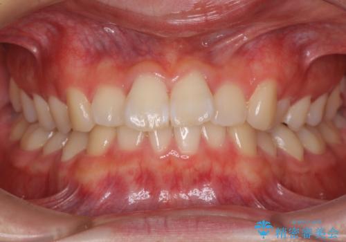 深い咬み合わせとデコボコ ワイヤー矯正で短期治療の症例 治療前