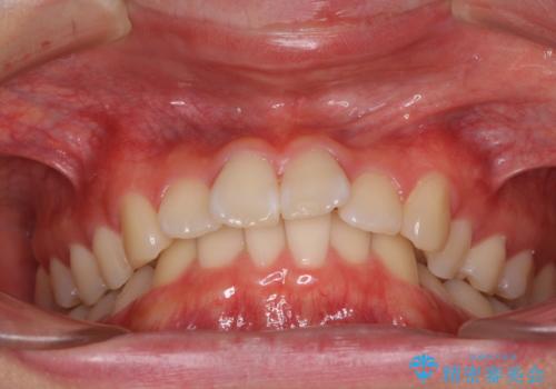 深い咬み合わせとデコボコ ワイヤー矯正で短期治療の治療前