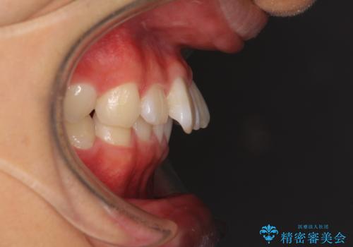 深い咬み合わせとデコボコ ワイヤー矯正で短期治療の治療前