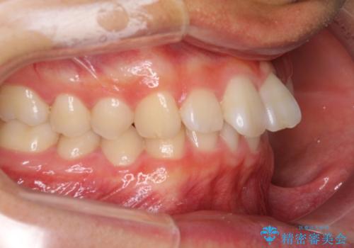 深い咬み合わせとデコボコ ワイヤー矯正で短期治療の治療前