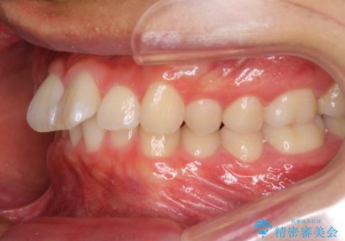 深い咬み合わせとデコボコ ワイヤー矯正で短期治療の治療前