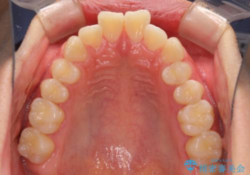 深い咬み合わせとデコボコ ワイヤー矯正で短期治療の治療前