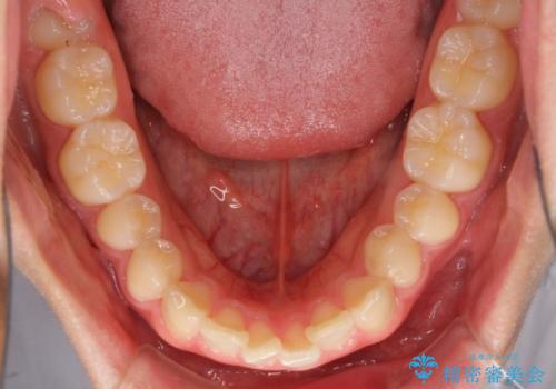 深い咬み合わせとデコボコ ワイヤー矯正で短期治療の治療前