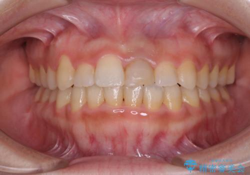 前歯のクロスバイトと変色した歯 ワイヤー矯正とセラミック治療の治療前