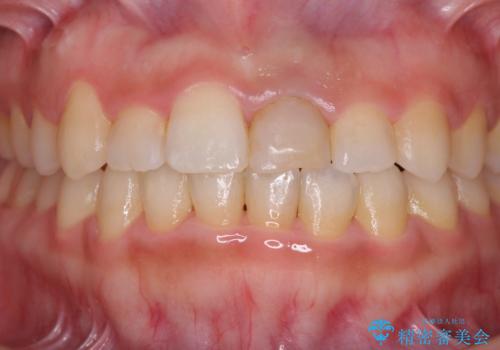 前歯のクロスバイトと変色した歯 ワイヤー矯正とセラミック治療の治療中