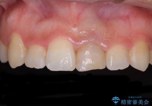 前歯のクロスバイトと変色した歯　ワイヤー矯正とセラミック治療の治療中