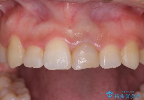 前歯のクロスバイトと変色した歯 ワイヤー矯正とセラミック治療の治療中