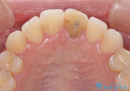 前歯のクロスバイトと変色した歯 ワイヤー矯正とセラミック治療の治療中