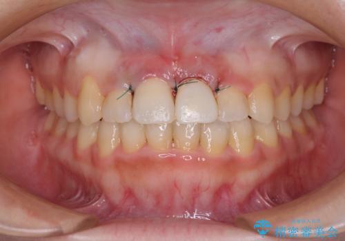 前歯のクロスバイトと変色した歯 ワイヤー矯正とセラミック治療の治療中