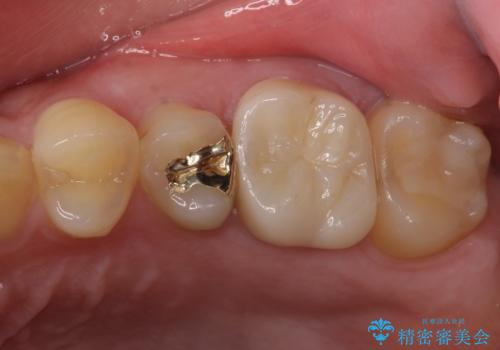 目立つ銀歯を治したい　奥歯のむし歯治療の治療後
