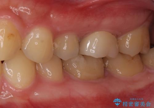 目立つ銀歯を治したい 奥歯のむし歯治療の治療後