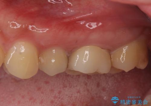 目立つ銀歯を治したい 奥歯のむし歯治療の治療後