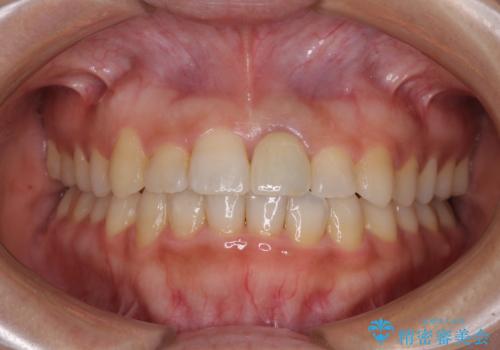 前歯のクロスバイトと変色した歯　ワイヤー矯正とセラミック治療の症例 治療後