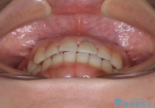 前歯のクロスバイトと変色した歯 ワイヤー矯正とセラミック治療の治療後