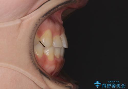 前歯のクロスバイトと変色した歯 ワイヤー矯正とセラミック治療の治療後