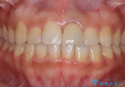 前歯のクロスバイトと変色した歯 ワイヤー矯正とセラミック治療の治療後