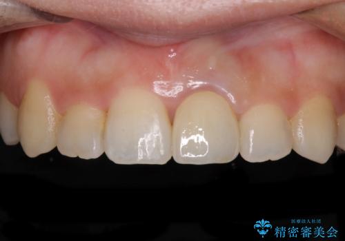 前歯のクロスバイトと変色した歯 ワイヤー矯正とセラミック治療の治療後