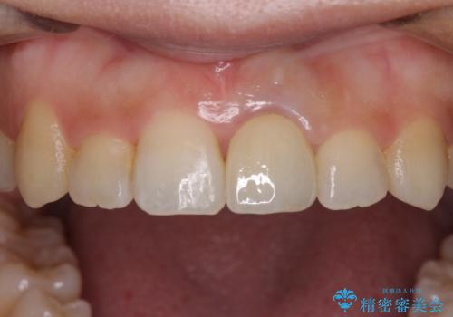 前歯のクロスバイトと変色した歯 ワイヤー矯正とセラミック治療の治療後