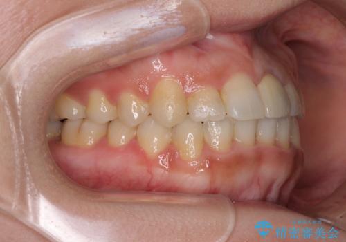 前歯のクロスバイトと変色した歯　ワイヤー矯正とセラミック治療の治療後