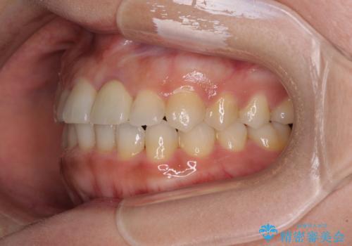 前歯のクロスバイトと変色した歯 ワイヤー矯正とセラミック治療の治療後