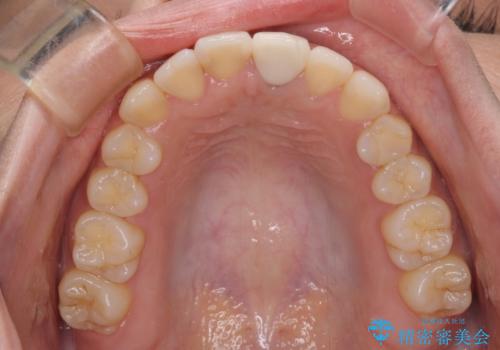 前歯のクロスバイトと変色した歯　ワイヤー矯正とセラミック治療の治療後
