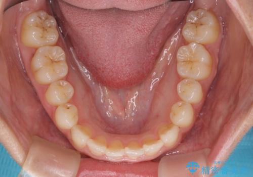 前歯のクロスバイトと変色した歯 ワイヤー矯正とセラミック治療の治療後