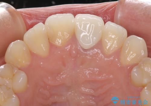 前歯のクロスバイトと変色した歯 ワイヤー矯正とセラミック治療の治療後