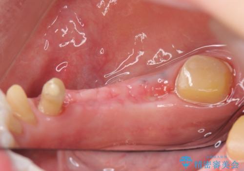 インプラント 抜歯になってしまった歯の補綴の治療前