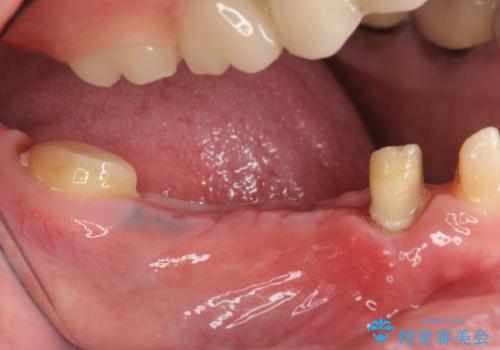 インプラント 抜歯になってしまった歯の補綴の治療前