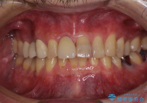 折れてしまった前歯 インプラントによる補綴治療の治療後