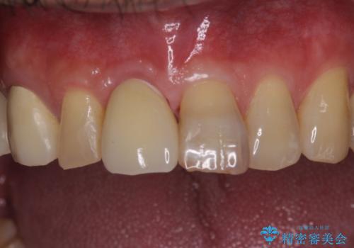 折れてしまった前歯 インプラントによる補綴治療の症例 治療後