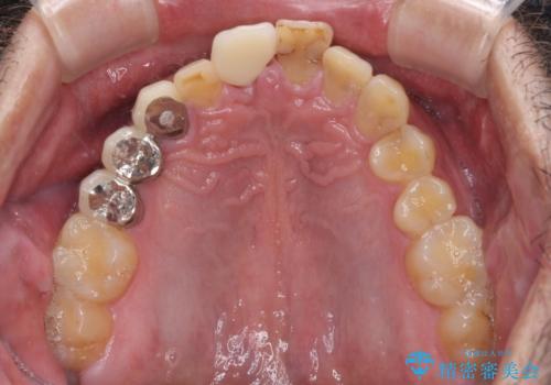 折れてしまった前歯 インプラントによる補綴治療の治療後
