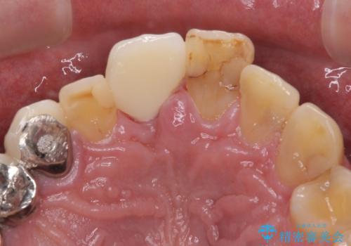 折れてしまった前歯 インプラントによる補綴治療の治療後
