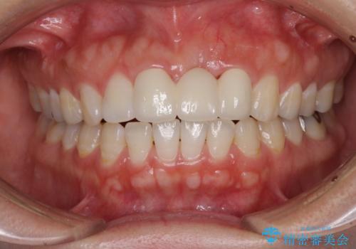 前歯のブリッジが気に入らない　歯肉移植術を併用した前歯のブリッジ