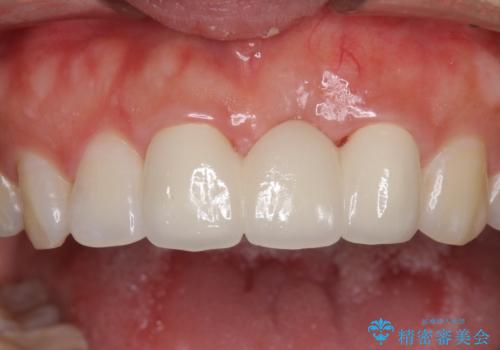 前歯のブリッジが気に入らない　歯肉移植術を併用した前歯のブリッジの治療後