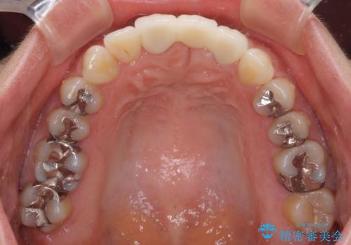 前歯のブリッジが気に入らない　歯肉移植術を併用した前歯のブリッジの治療後