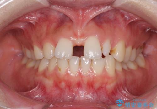 欠損歯と矮小歯　矯正治療と前歯のセラミック治療の症例 治療前