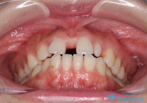 欠損歯と矮小歯　矯正治療と前歯のセラミック治療の治療前