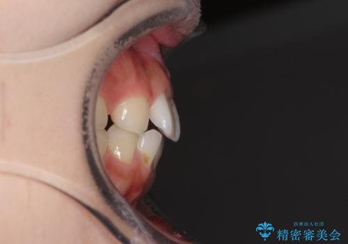 欠損歯と矮小歯　矯正治療と前歯のセラミック治療の治療前
