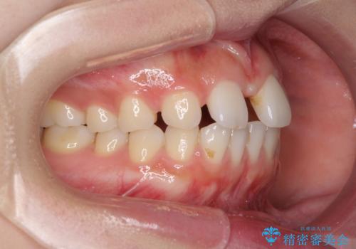 欠損歯と矮小歯 矯正治療と前歯のセラミック治療の治療前